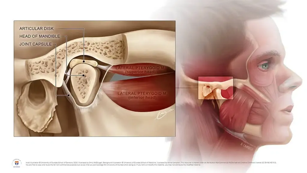 Temporomandibular joint disorder