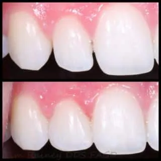 Composite Veneers — before and after