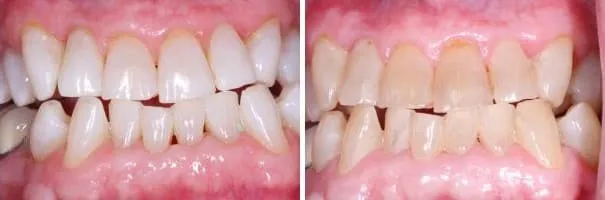 Comparison of clean white teeth and stained, yellowed teeth in a before-and-after view.