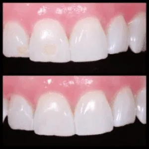 A before and after photo of a person’s teeth with yellow stains.