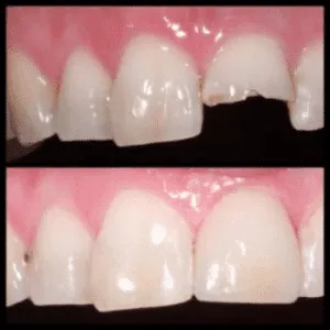 A close-up of a person’s teeth with a hole in them, before and after treatment.