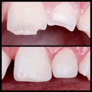 A before and after image of a person’s teeth. The before image shows the person’s teeth with a chipped tooth, and the after image shows the person’s teeth with the chipped tooth repaired.