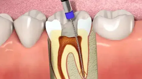 General & Family Dentistry 2 The image shows a dentist using a drill to remove the root of a tooth.