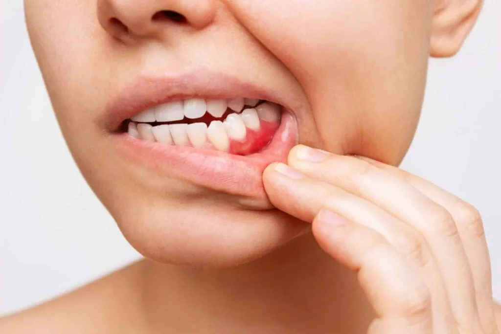 Person showing gums with visible inflammation.