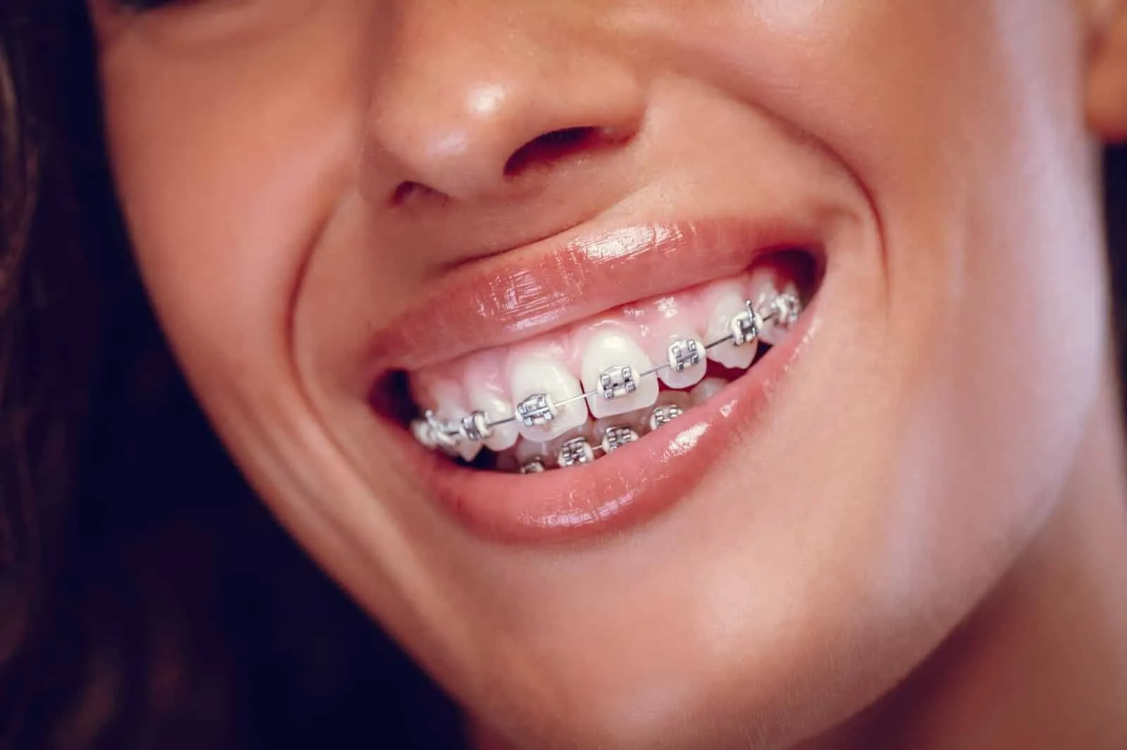 A close-up of a woman smiling with braces on her teeth.