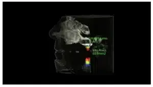 3D scan of a nasal cavity showing airflow with data on volume and minimum area.