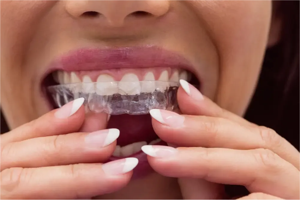 Person inserting clear dental aligner tray.