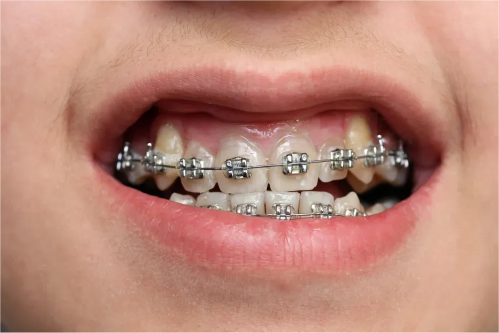 Child’s mouth showing dental braces.