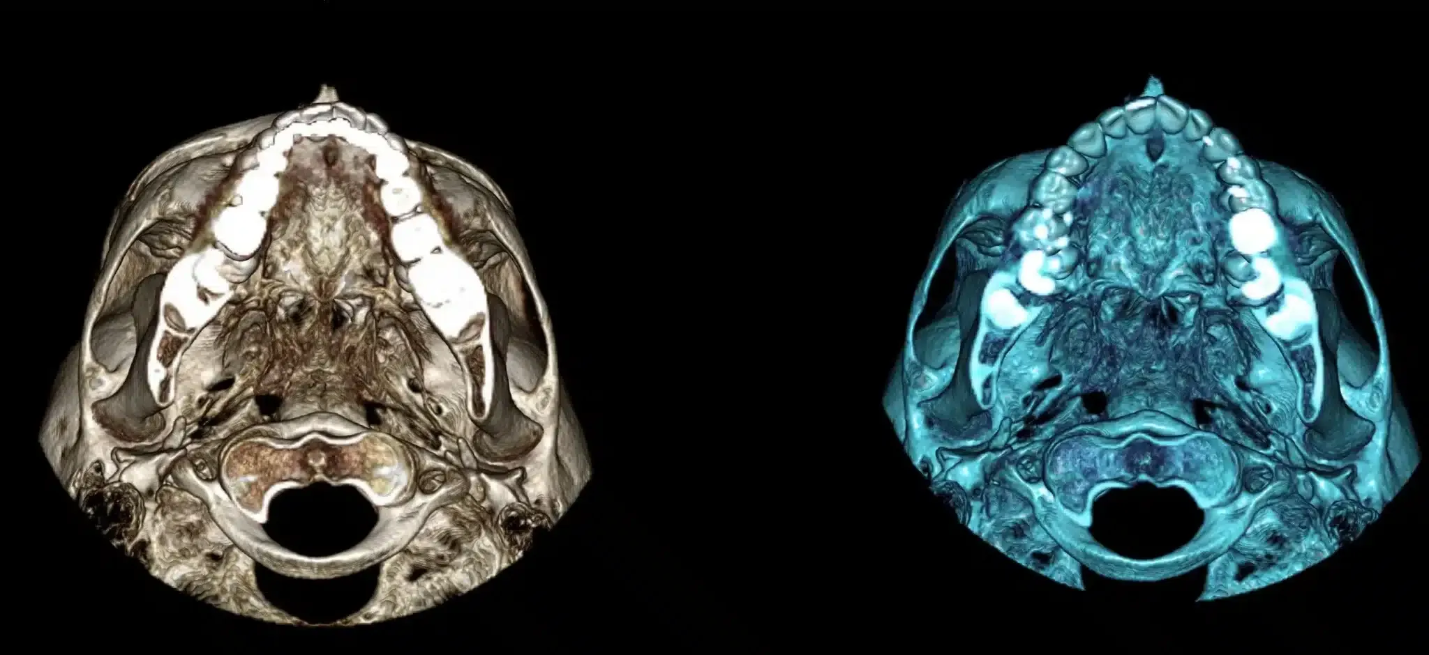Two CT scan images of a skull on a black background