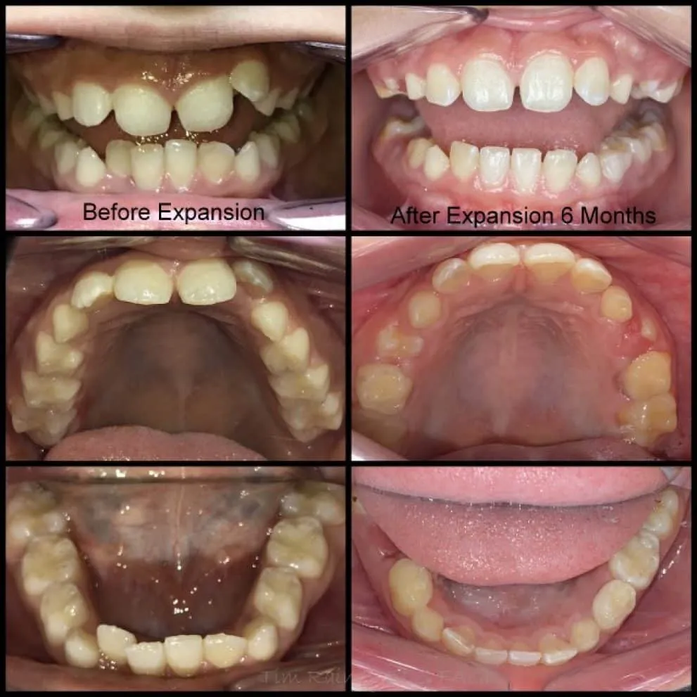 The image shows a before and after photo of a child’s teeth. The left photo shows the child’s teeth before expansion, and the right photo shows the child’s teeth after expansion.