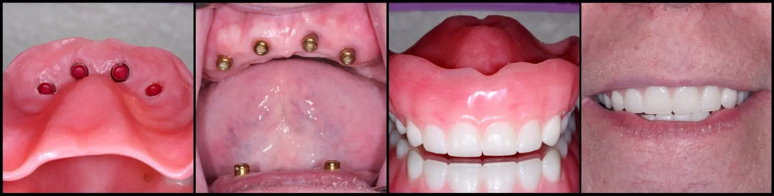 Denture-Implant-Options