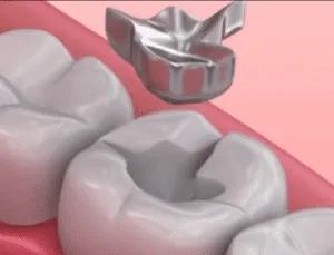 A dentist placing a metal crown on a tooth.