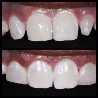 Tooth-Colored Filling treating Peg Laterals — before and after