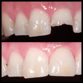 Tooth Colored Filling — before and after
