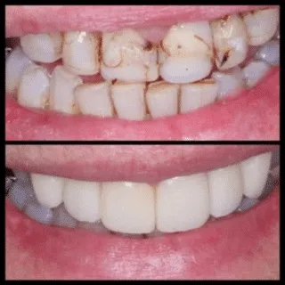 Porcelain Veneers — before and after