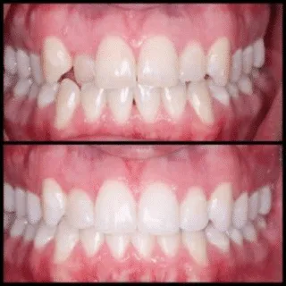 Clear Aligners — before and after