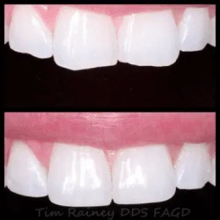 Tooth-Colored Filling — before and after