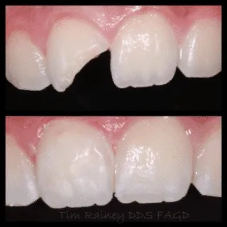 Tooth-Colored Filling — before and after