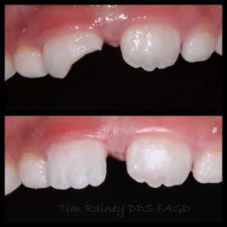 Tooth-Colored Filling — before and after