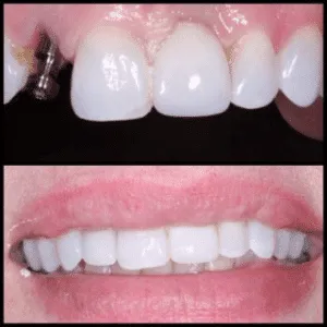 A before-and-after image of a person’s teeth, showing the results of dental treatment.