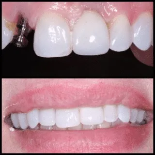 Dental Implant — before and after