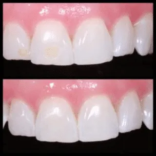 Tooth-Colored Filling — before and after