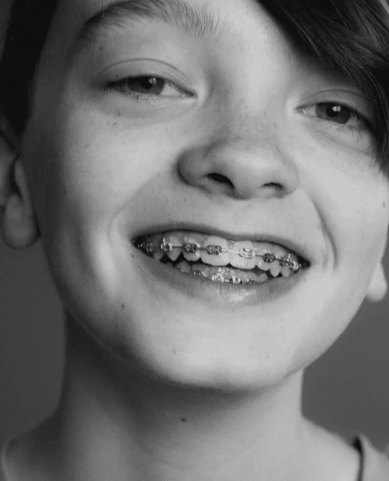 Image of a woman teeth with braces