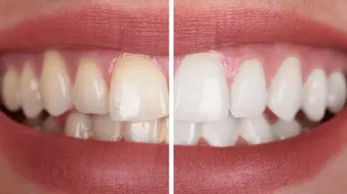 Tips For Optimal Oral Hygiene Before-and-after photo of teeth whitening. The left photo shows yellowed teeth, and the right photo shows white teeth.